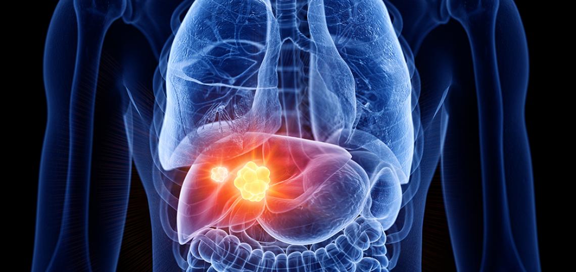 Unveiling challenges & innovations in Hepatocellular Carcinoma screening! Despite rising rates, screening is underutilized. How can we bridge this gap? Dive into this review article for insights & advancements! 📚 Read more: ow.ly/32wa50RbUEh #HepatocellularCarcinoma