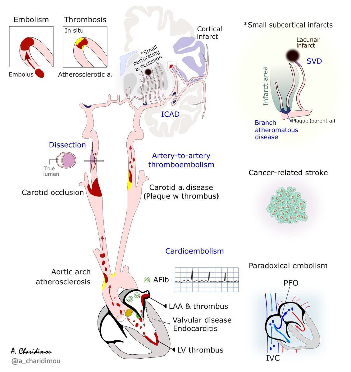 🧠⭕️Ischemic stroke ~ for accurate diagnosis, and hence management, key features need to be defined:

1. Location
⭕️Vascular (&amp; brain) anatomy (e.g. R MCA)

2. Pathophysiology
📌Mechanism (e.g. cardioembolism)
📌Underlying disease processes (e.g. AFib, cancer)

3. Vascular,