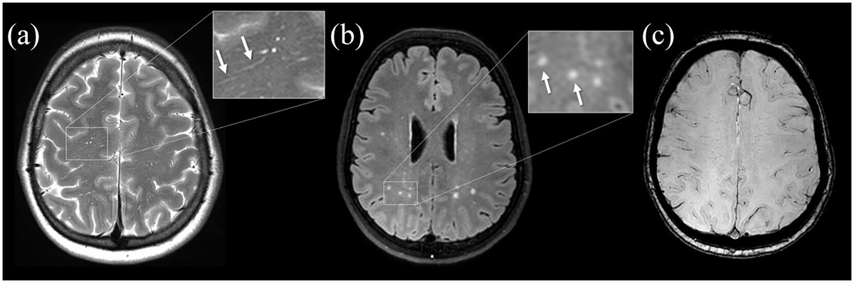 🩸🧠Concept validation of new Boston criteria v2.0 for Cerebral Amyloid Angiopathy (CAA) diagnosis @IntJStroke 🧬In Dutch-type hereditary CAA the new Boston criteria increase the sensitivity for capturing presymptomatic mutation carriers, **before the appearance of any…