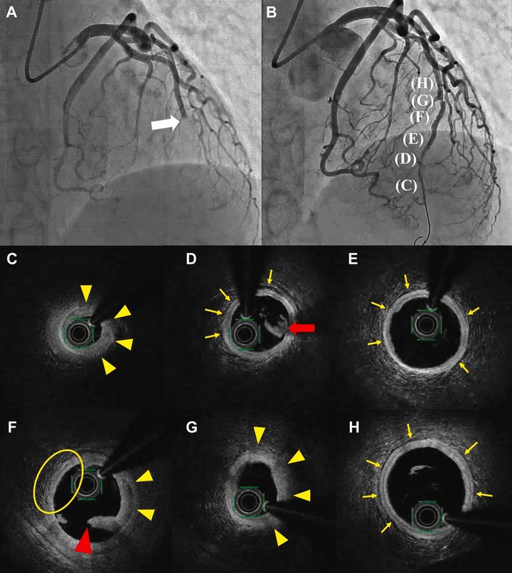 59 y/o ♀️ transferred to ED from another hospital ➡️ sudden-onset strong chest pain w/ ST-segment elevation in leads V1-V6 on #ECG. She experienced mental distress for 1 week & was current smoker w/ Hx of 36 pack-yrs bit.ly/3vEhryY #JACCCaseReports #SCAD #cvAMI #STEMI