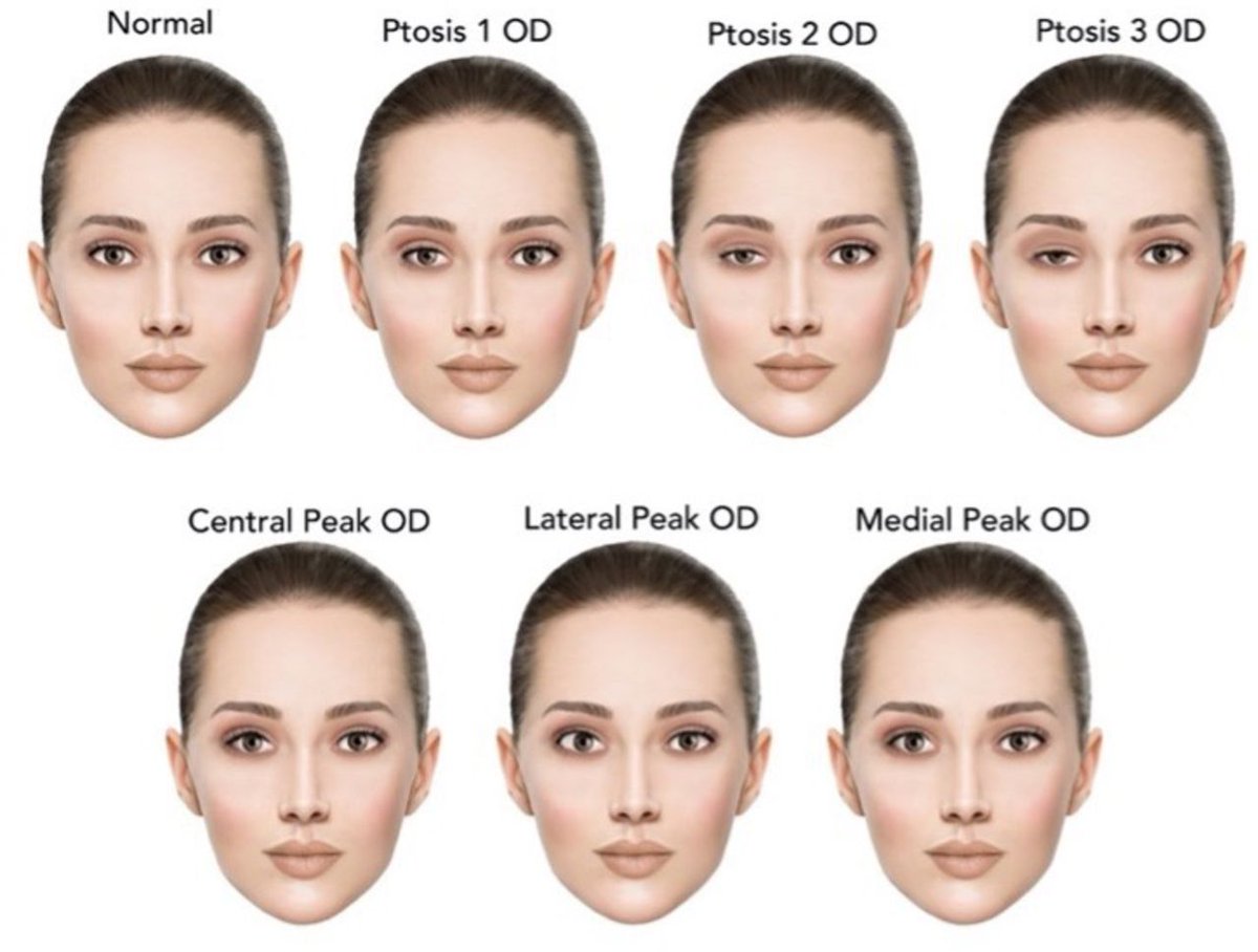 #Oculoplastic surgeons assess eyelid asymmetry and #ptosis more accurately and quickly in patients at an upright orientation compared to different spatial perspectives: bit.ly/49vGkLl #plastics #surgery #eyelid #eyes #health