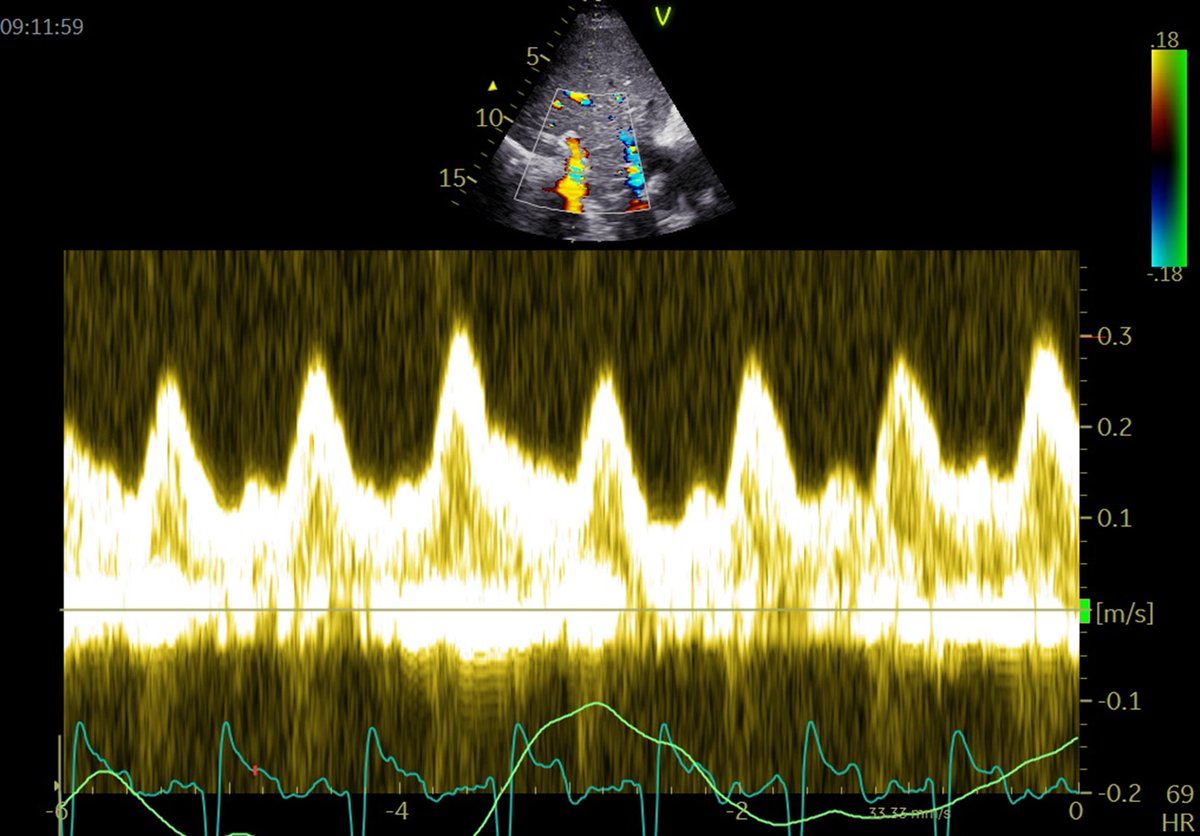 What is this 👇? #VExUS #POCUS See thread 🪡 for additional doppler and 2D data
