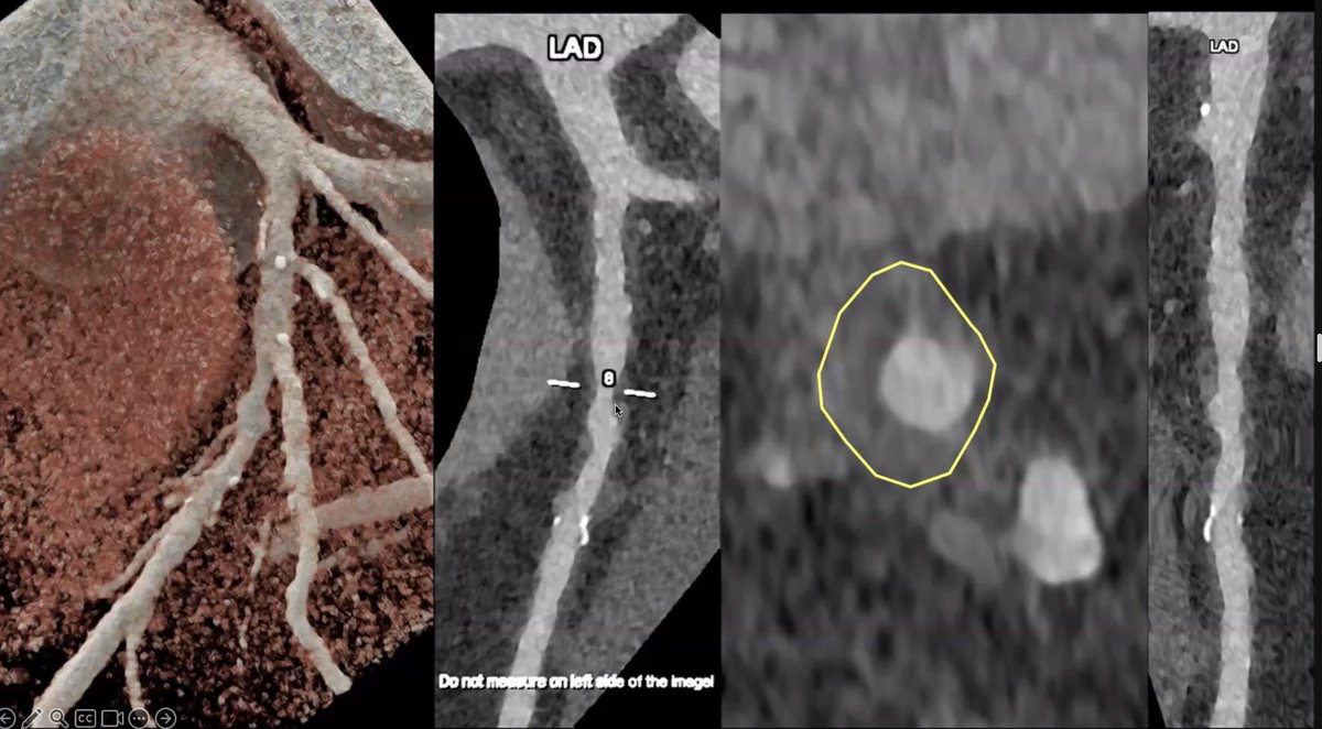 'Photon counting CT will change the world of cardiovascular imaging' --- Prof Cademartiri delivering a truly spectacular @BWHCVImaging grand rounds on #PCCT #Plaque #CAD