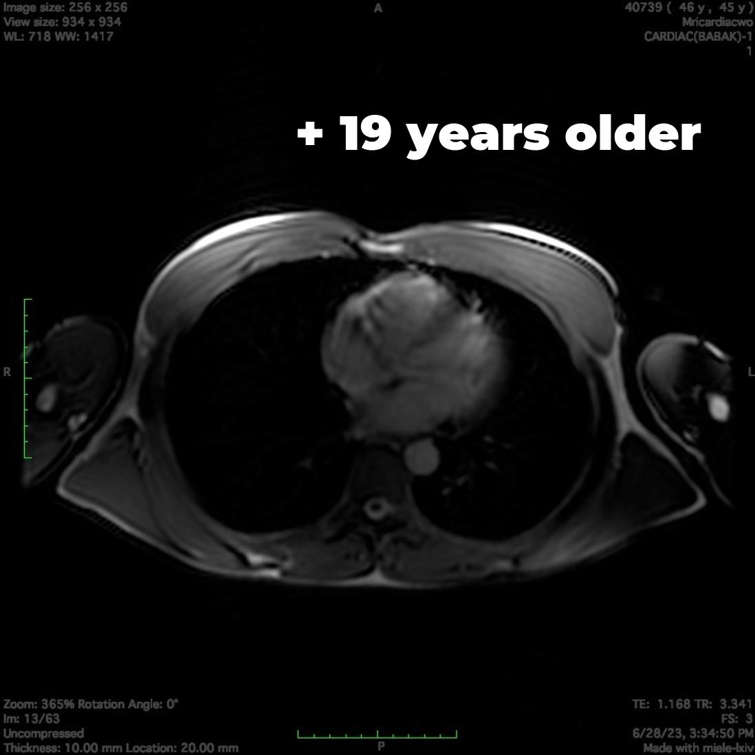 My lungs aged 19 years after having COVID. After 18 months and numerous interventions, my lungs still have not regained full capacity. + In 2021, my lung capacity was age 26. + By Nov 2022, after getting covid, my lung capacity was age 45. + Now 2024, my lung capacity is age…