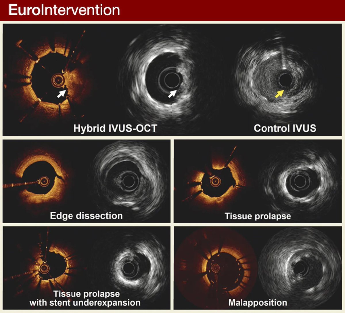 Hybrid IVUS-OCT systems can overcome the limitations associated with each technology and integrate the advantages of both modalities. Recently, a novel hybrid imaging system (PANOVISION) was approved for clinical use and tested in this noniferiority trial. #EIJBestOf