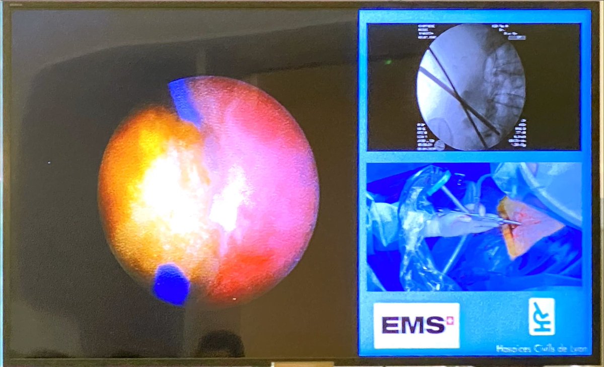 @StephanKochEMS @abidnadia_uro @drjanakddesai Thrilled to celebrate @abidnadia_uro’s outstanding PCNL workshop—a true masterclass in organization and interactivity, made possible with the invaluable support of @SwissUrologyAcademy. Special thanks to @drjanakddesai a luminary of endourology, for gracing us with his presence.