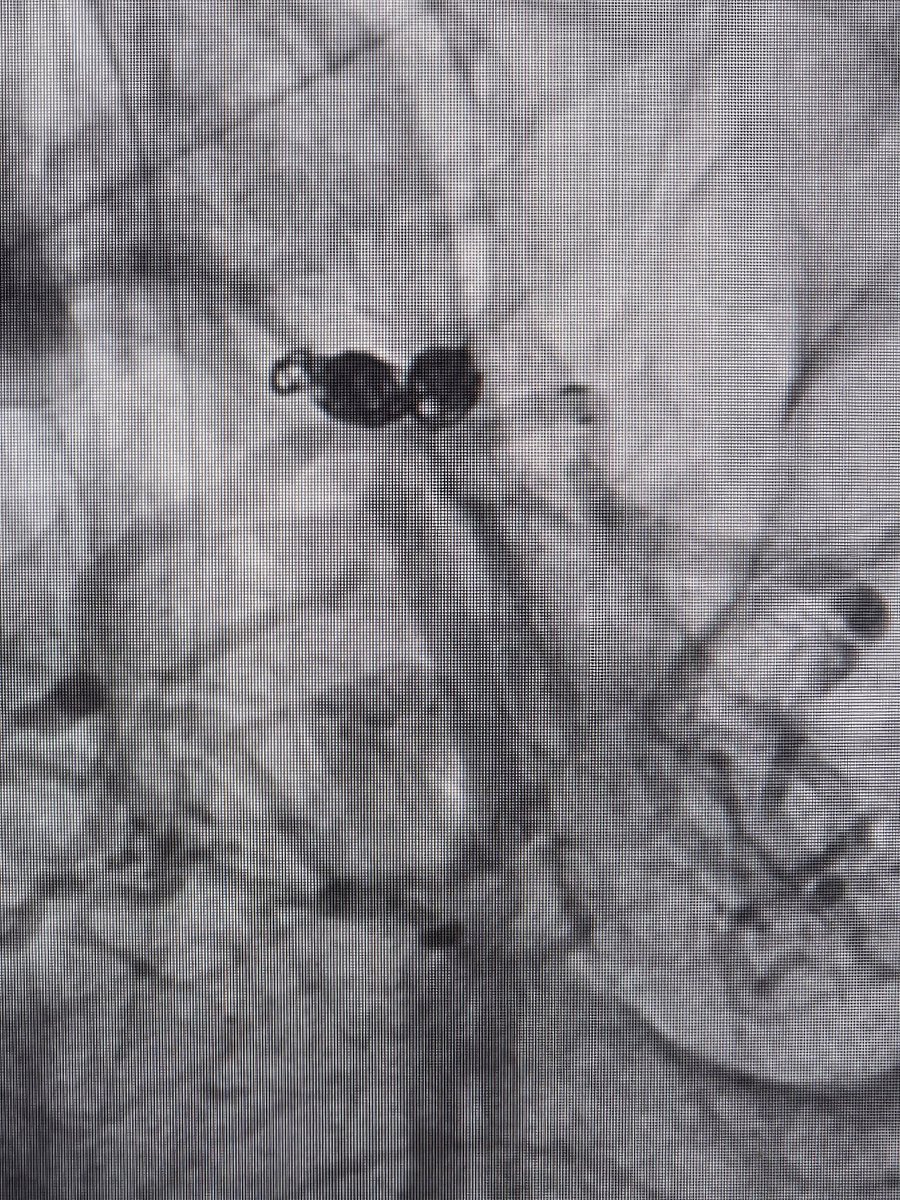 SharathKumarGG7's tweet image. Ruptured wide neck basilar top aneurysm, treated with Stent assisted coiling successfully! #Aneurysm #Coiling #Endovascular #BrainAneurysm #Sah #Neurointervention #NeuroRad #Neurosurgery #StentAssistedCoiling