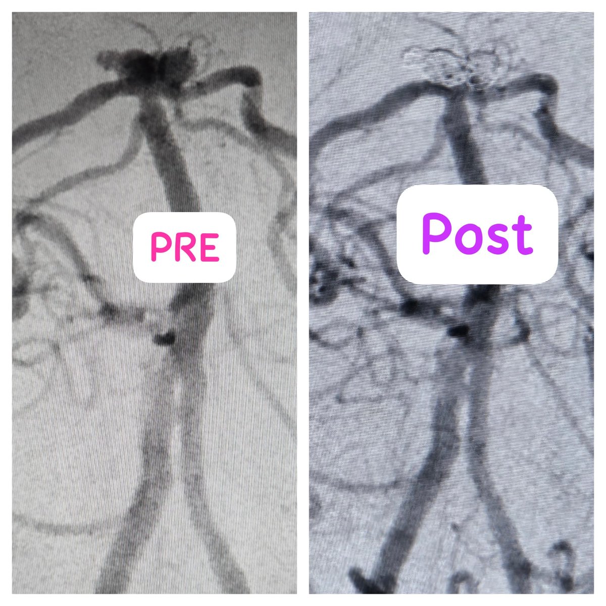 SharathKumarGG7's tweet image. Ruptured wide neck basilar top aneurysm, treated with Stent assisted coiling successfully! #Aneurysm #Coiling #Endovascular #BrainAneurysm #Sah #Neurointervention #NeuroRad #Neurosurgery #StentAssistedCoiling