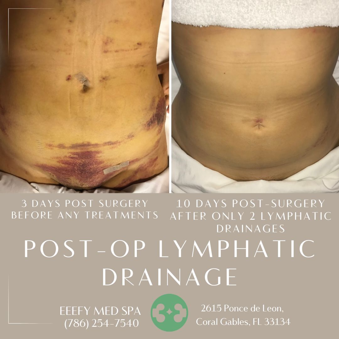 EeefyMedSpa's tweet image. 💯Discover the magic of Post-Op Lymphatic Drainage at EEEFY MED SPA!  🌿✨ #PostOpRecovery #LymphaticDrainage #EEEFYMEDSPA 📞 7862457540 or just VISIT US @ 2615 Ponce de Leon Blvd Coral Gables, Fl 33134