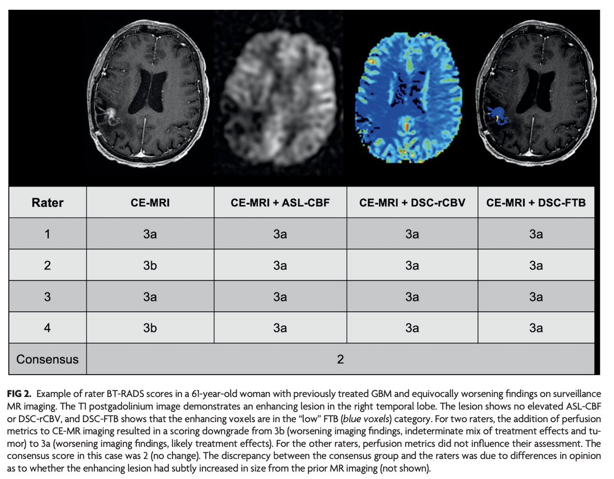 TheAJNR's tweet image. "Arterial Spin-Labeling and DSC Perfusion Metrics Improve Agreement in Neuroradiologists’ Clinical Interpretations of Posttreatment High-Grade Glioma Surveillance MR Imaging"

doi.org/10.3174/ajnr.A…

#OpenAccess #ASL @Michael_Iv_MD