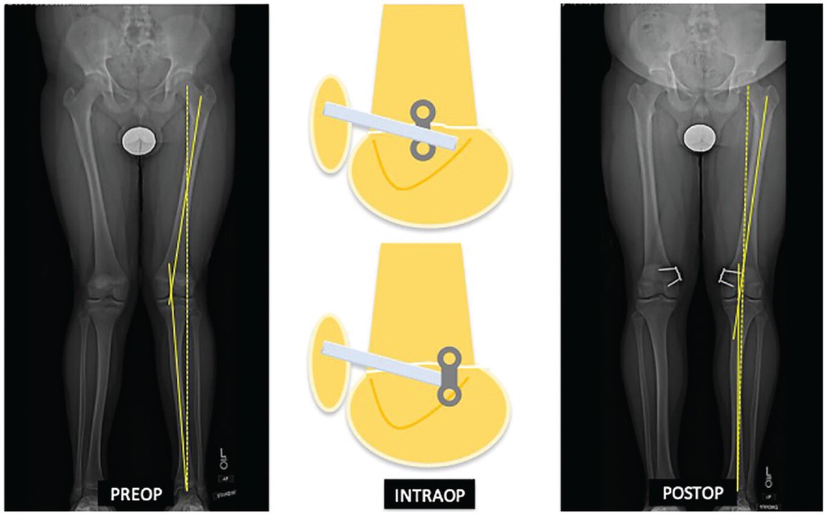 Guided growth corrects genu valgum, a known risk factor for patellar instability, in skeletally immature patients undergoing MPFL reconstruction. But what are the risks? @prismsportsmed @cincykidsortho @Jupiter_Studies ow.ly/abr250R9bpR