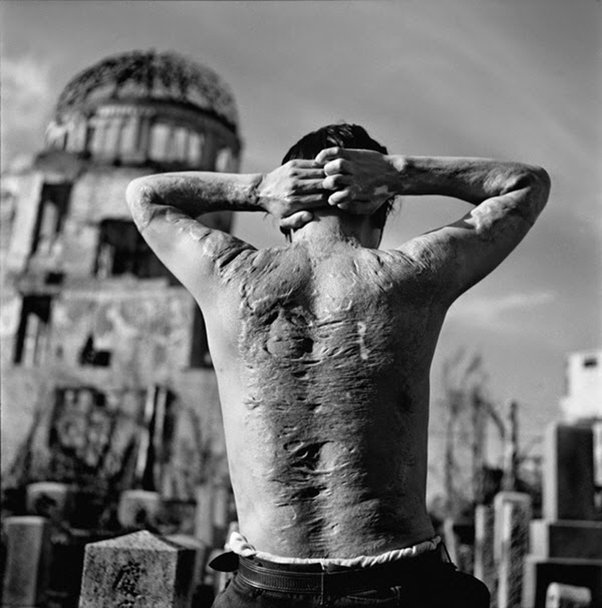 A photograph depicting the body of a survivor from Hiroshima.