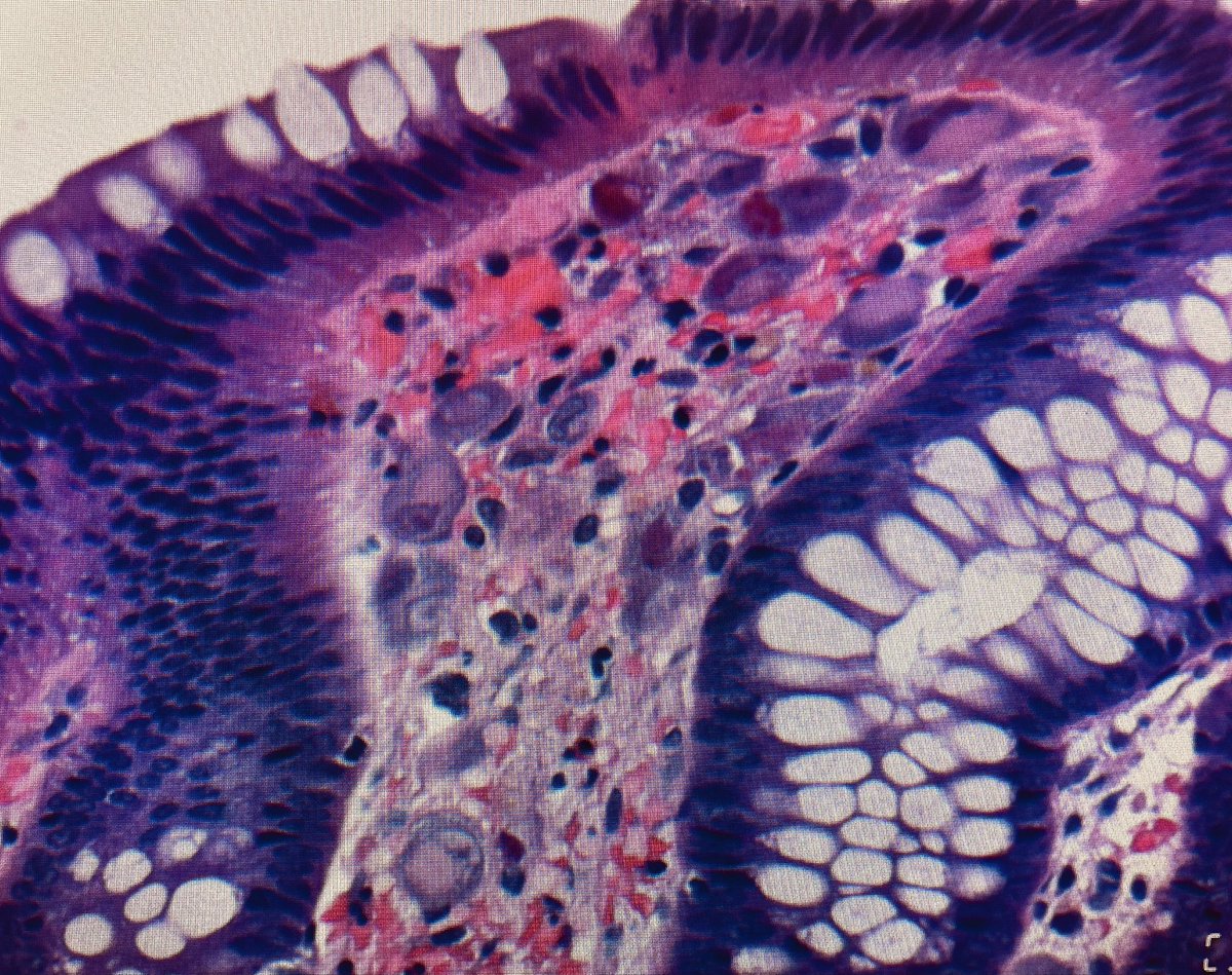 Cytomegalovirus colitis: CMV infects endothelial cells and cause “owl’s eye” smudgy inclusions.