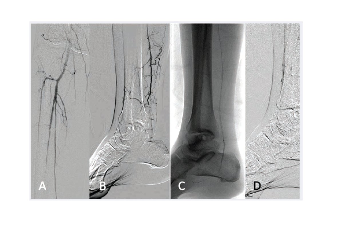 The HawkOne™ Directional Atherectomy System Puts Control in the Hands of the Operator CLD talks with Michael J. Paisley, MD, and Brant W. Ullery, MD, FACS, RPVI okt.to/BMJ4ge