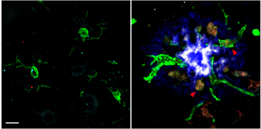 Microglia expressing the inhibitory receptor LILRB4 laze around plaques in #Alzheimersdisease and amyloidosis mice. An antibody against LILRB4 stirred microglia to engulf Aβ fibrils and lower plaque load. @WUSTL ow.ly/7zvU50RexJh
