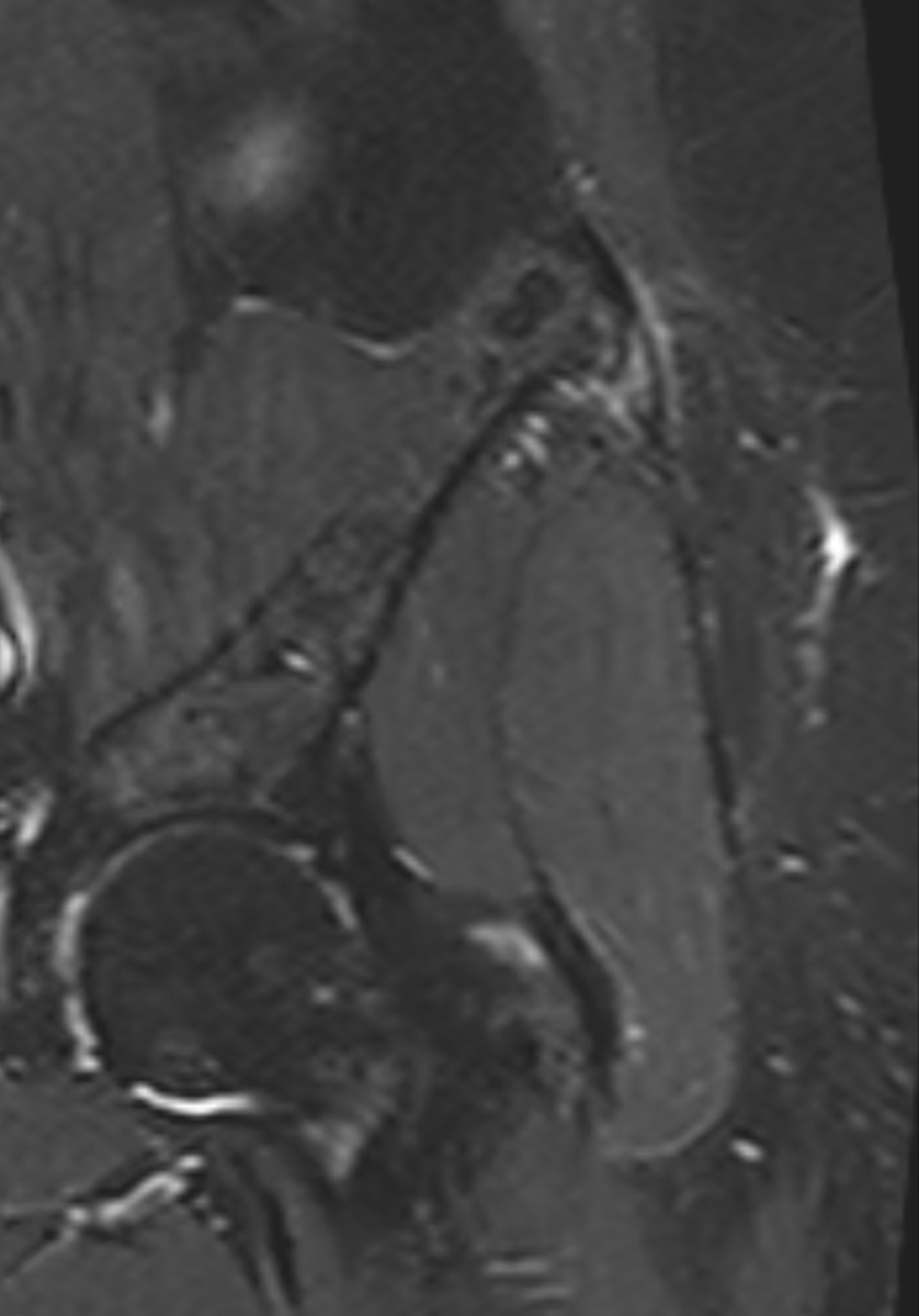 So called Proximal ITB syndrome. More of a enthesopathy, with thickening and microtearring of the origin of the ITB. Prominent edema and inflamatory response around it. Looks painful.