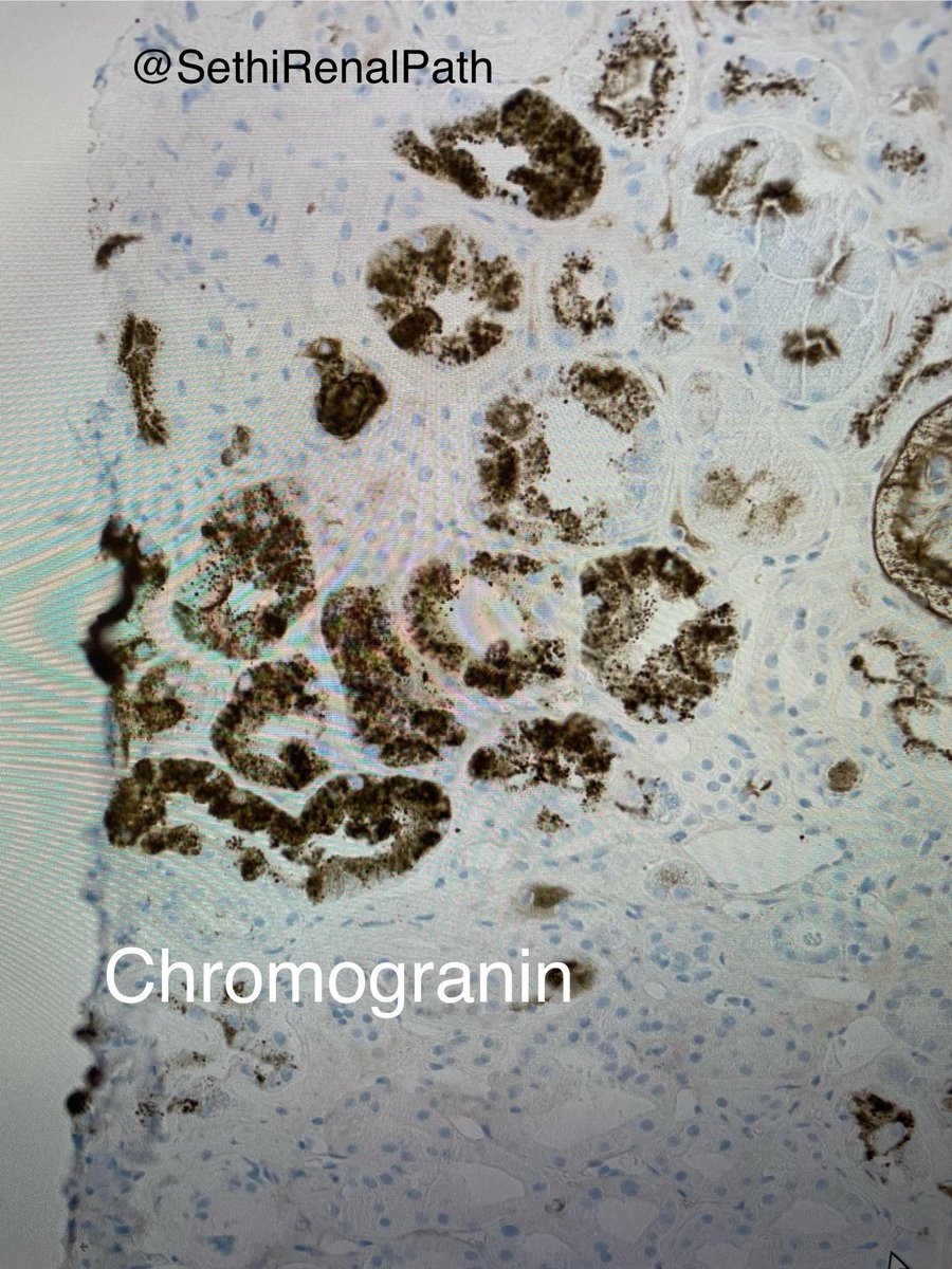 I had no idea at first, then it suddenly hit me. 1. Normal glomeruli,no FSGS 2. Tubules filled with large granules 3. IF negative=not light chain tubulopathy Chromogranin +++ in tubules Dx: Neuroendocrine tumor-associated tubulopathy 65-yr, diabetes, HTN, pancreas mass, ⬆️ Cr