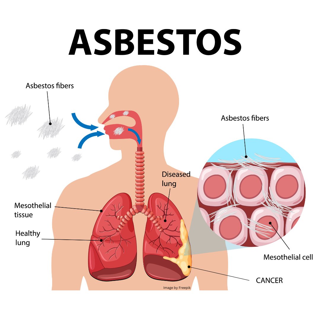 OmegaEnviron's tweet photo. When it comes to hazardous materials like asbestos, even the tiniest fibers can spell disaster for our health. 🚫💔 These microscopic particles can lead to lung diseases and cancer. 😷💥

https://t.co/0ZAopf6Zwe

But here's the good news: COMPLIANCE🌟🛡️

🌎#SafetyFirst #asbestos https://t.co/mdsu3tMViE