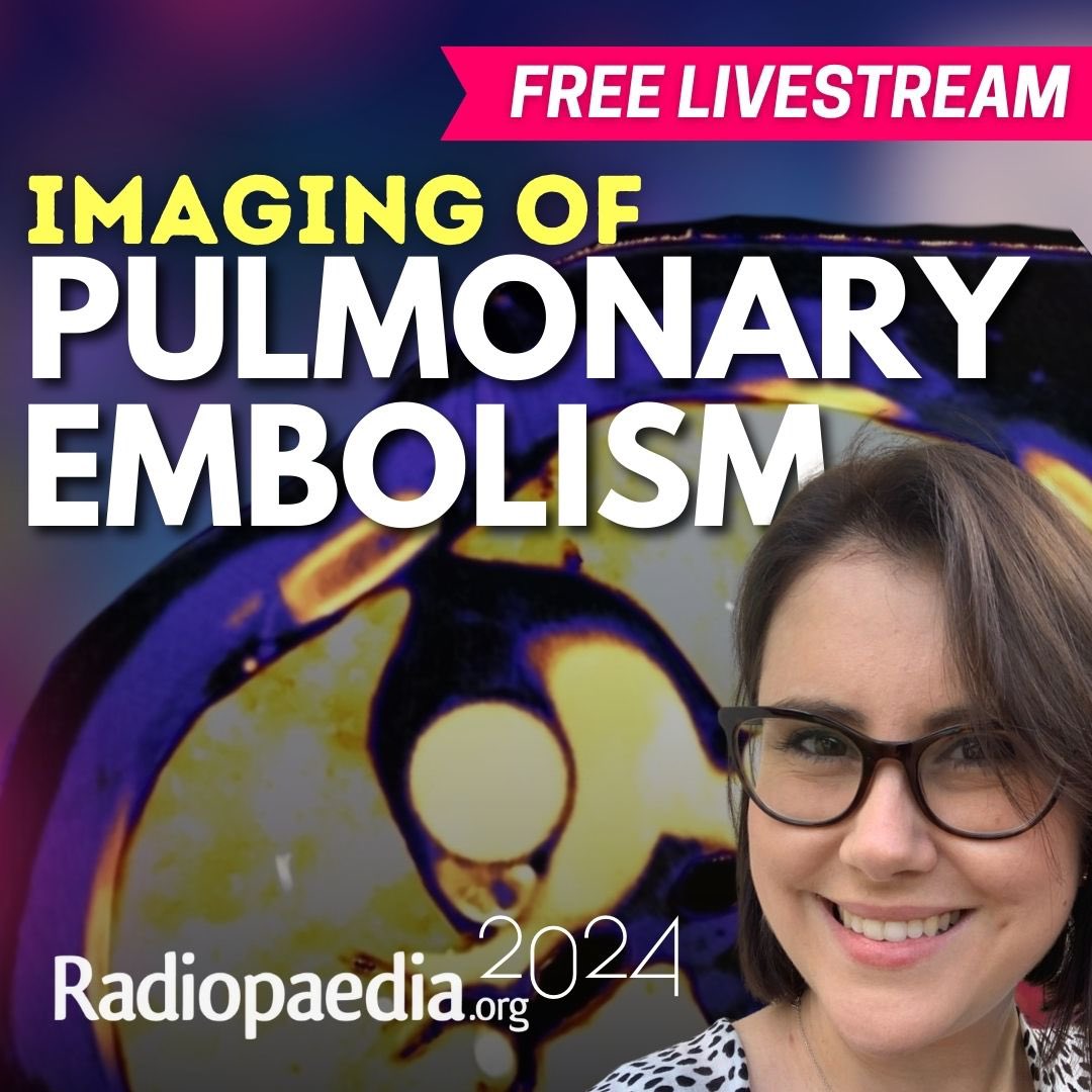 Free live-stream coming up later today on our YouTube Channel with @SalAyesa and @murf1990! 🫁 Imaging of pulmonary embolism ⏰ Visit link to find your local time youtube.com/radiologychann… #chestrad #radres #Radiopaedia2024