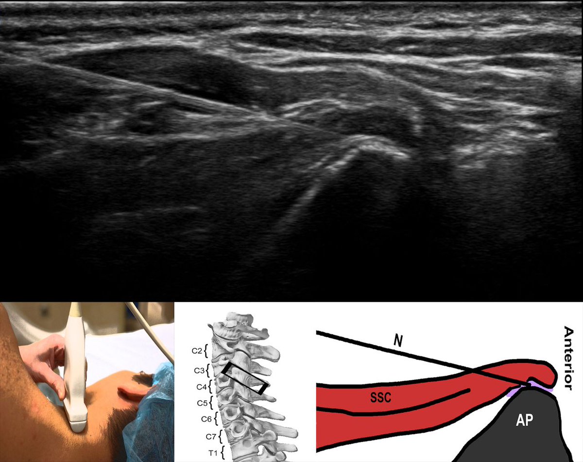 Fluoroscopic vs. Ultrasound Guidance 🤔 Fascinating article investigates the use of ultrasound guidance (USG) cervical medial branch blocks (CMBBs) 💉 instead of the standard fluoroscopic guidance blocks Link: bit.ly/3vNAHtU @ASRA_Society #USG #RegionalAnesthesia