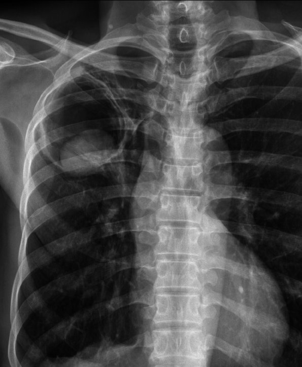 A 33-year-old man with a recent hospitalization for MRSA pneumonia presents with fever. His chest x-ray is shown below. Serum galactomannan antigen is positive. Diagnosis and management?

Learn more and generate your own questions at
neuralconsult.com 🧠 🎯

Photo: See