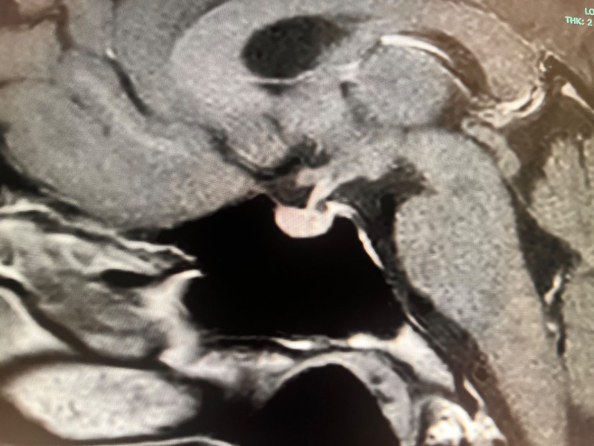 Question for any neurorads/head and neck people: What do you make of the small cystic thing posterior to the stalk? A bit too posterior for a Rathke cleft cyst? Some sort of cystic dilation of the posterior intercavernous sinus? Images are T1 pre, T2 sag/cor and T1 post
