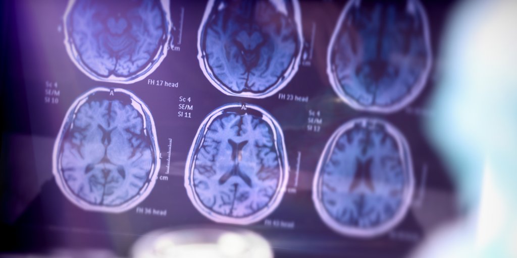 Matthew W. Pease, MD, Assistant Professor of Neurological Surgery, chimes in on how post-traumatic epilepsy is associated with a higher risk of dementia via @NeurologyToday: bit.ly/3vIxv2P
