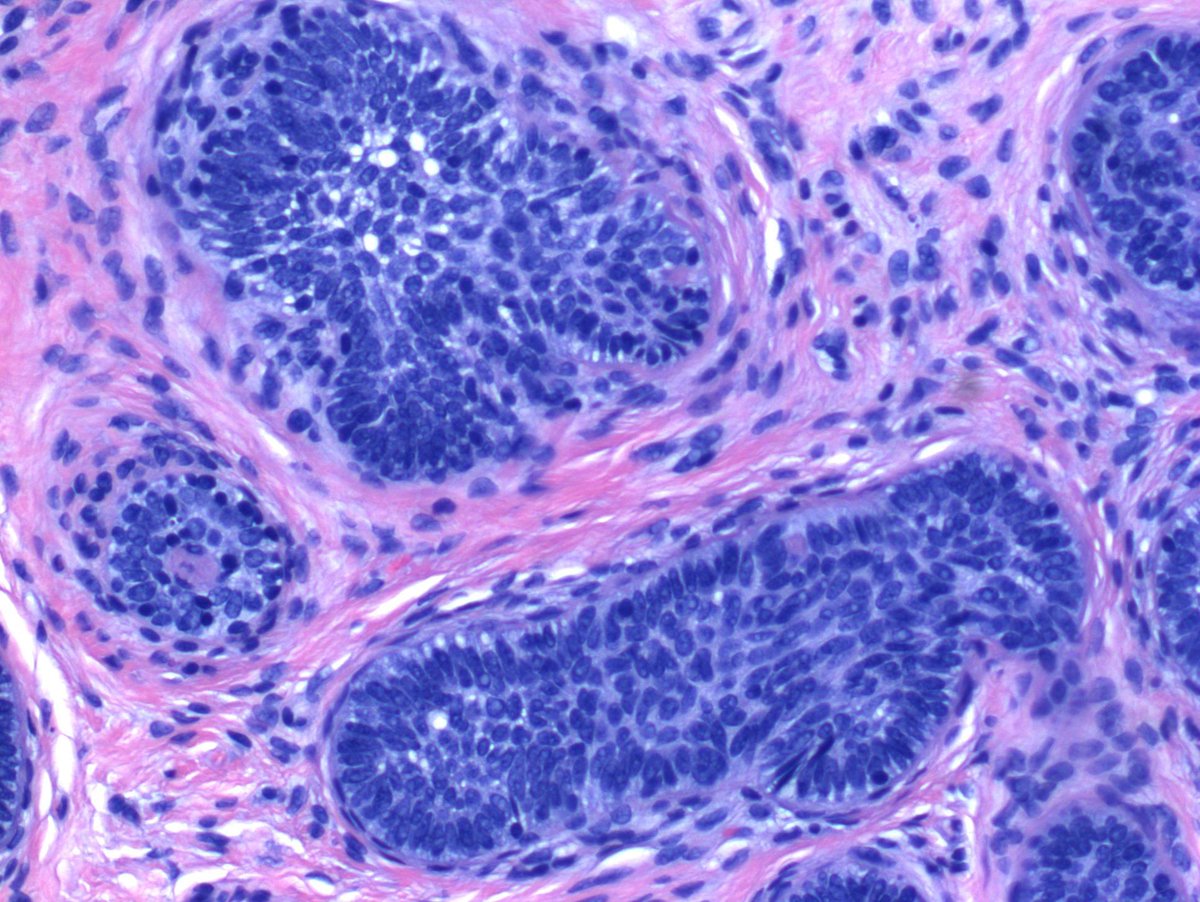 25 yo F scalp. NUB vs Neurofibroma.
So pretty 😍 

#skin #dermpath #dermatology #dermatopathology #pathology #skindoc #dermresident #dermboards #dermboardsstudying #pathologist #dermatologia #dermatopatologia #surgicalpathology #surgpath  #pathtwitter #pathresident