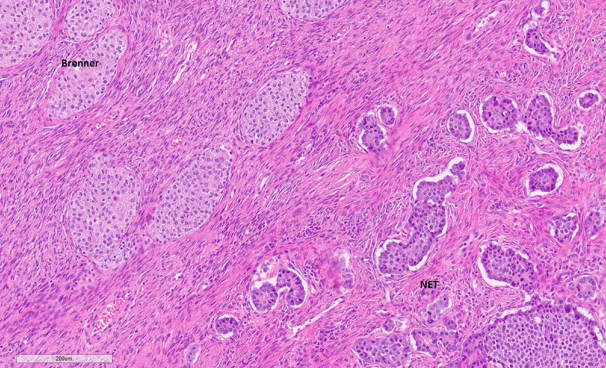 One ovary, two tumors!

1- Benign Brenner: Smooth contoured nests of bland transitional epithelium in fibromatous stroma. Oval, grooved nuclei.

2- Metastatic Well-differentiated neuroendocrine tumor (NET): Organoid tumor cell nests w/ round nuclei & “salt and pepper” chromatin.