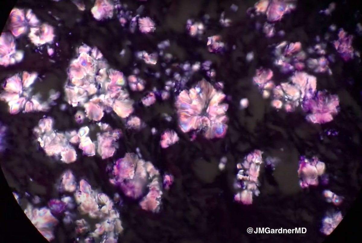 What are these rainbow-colored polarizable flower-shaped crystals? Reply with your diagnosis then check answer here (plus video of polarization...mesmerizing!): kikoxp.com/posts/3767 #Pathology #dermpath #dermatology #dermatologia #dermtwitter #pathologists #pathTwitter