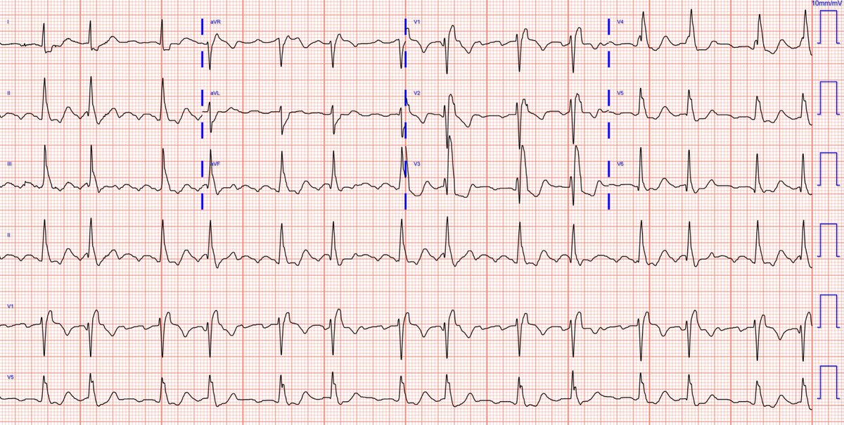 I have posted a virtually identical ECG in the past. But I know it will make @SergioPinski, @adribaran, and @DrDave01 happy.