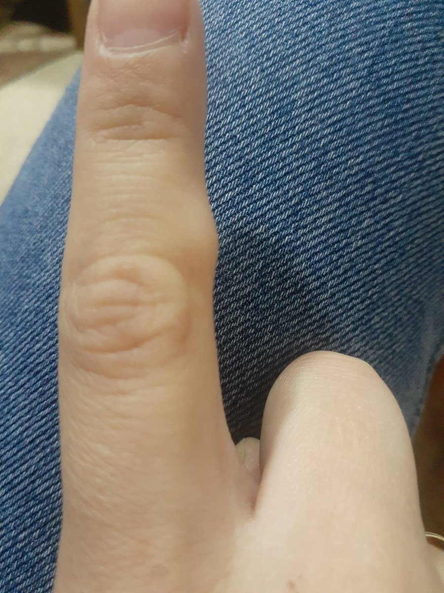 #MedTwitter #MedX #RheumTwitter Young female patient present with 10 days of the small swelling as shown in picture. There is no pain. The swelling is firm, subcutaneous. X-ray of the hand showed no bone changes. What would be the differential diagnosis? @DxRxEdu @rabihmgeha