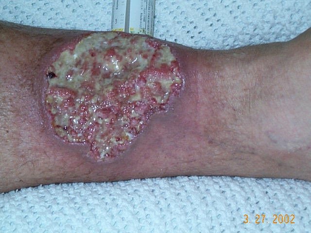 @DrSharadMutalik Pyoderma gangrenosum is a rare, painful ulcerative skin condition driven by neutrophilic inflammation. 

First-line therapies: systemic corticosteroids, ciclosporin, and TNF alpha inhibitors like infliximab.