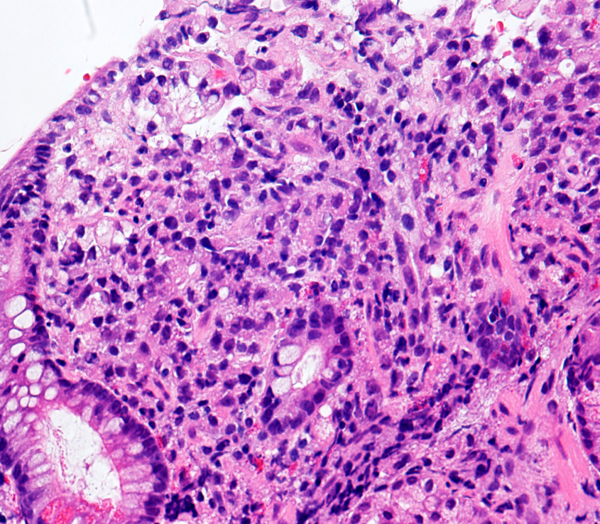Stomach biopsy, what would be your diagnosis only by seeing this slides? #GIpath