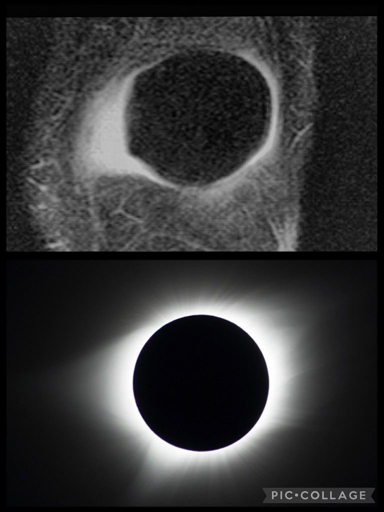 Patellar eclipse on coronal STIR image of the knee 🌚🌝