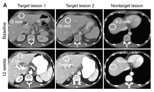 Andrew Waters (@andrewmwaters) on Twitter photo RMC-6236 achieved the impossible. A COMPLETE RESPONSE in a heavily pretreated PDAC patient w liver and peritoneal mets <a href="/CD_AACR/">Cancer Discovery</a>
Excited lab members <a href="/grace_goodhart/">Grace Goodhart</a> <a href="/ambermamparo/">Amber Amparo</a> could contribute to the <a href="/Nature/">nature</a> papers leading up to this
<a href="/KenOliveLab/">KenOliveLab</a> <a href="/SyedAAhmad5/">Syed A. Ahmad</a> <a href="/KRASKickers/">KRASKickers</a> RMC-6236 achieved the impossible. A COMPLETE RESPONSE in a heavily pretreated PDAC patient w liver and peritoneal mets <a href="/CD_AACR/">Cancer Discovery</a>
Excited lab members <a href="/grace_goodhart/">Grace Goodhart</a> <a href="/ambermamparo/">Amber Amparo</a> could contribute to the <a href="/Nature/">nature</a> papers leading up to this
<a href="/KenOliveLab/">KenOliveLab</a> <a href="/SyedAAhmad5/">Syed A. Ahmad</a> <a href="/KRASKickers/">KRASKickers</a>