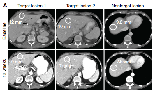 RMC-6236 achieved the impossible. A COMPLETE RESPONSE in a heavily pretreated PDAC patient w liver and peritoneal mets @CD_AACR Excited lab members @grace_goodhart @ambermamparo could contribute to the @Nature papers leading up to this @KenOliveLab @SyedAAhmad5 @KRASKickers