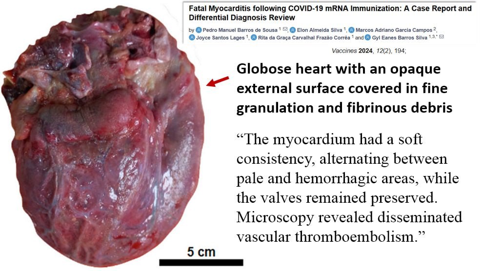 Myocarditis heart