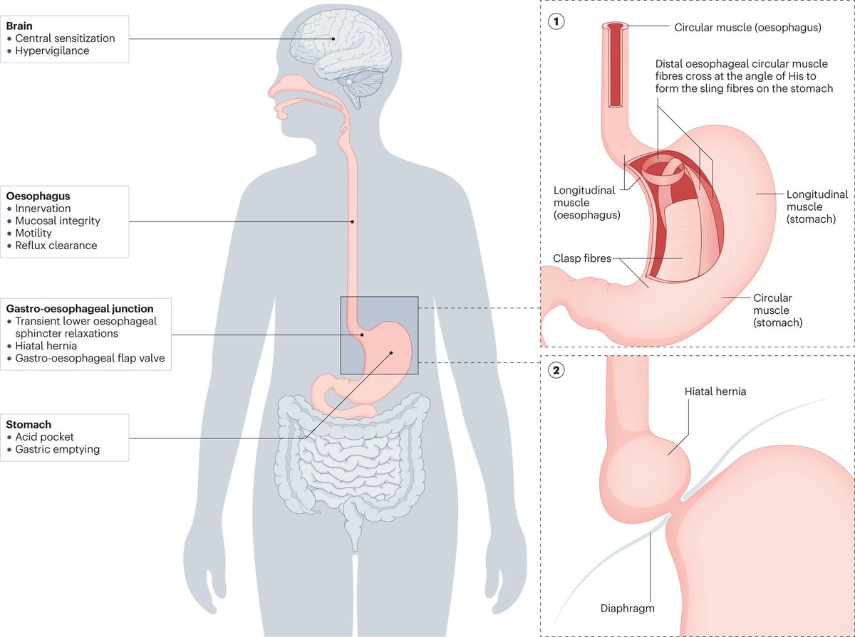 From our April issue, this REVIEW discusses the pathophysiology of gastro-oesophageal reflux disease and the implications for diagnosis and management, different GERD phenotypes have different degrees of reflux & severity of symptoms rdcu.be/dExtN #GORD #GERD #reflux