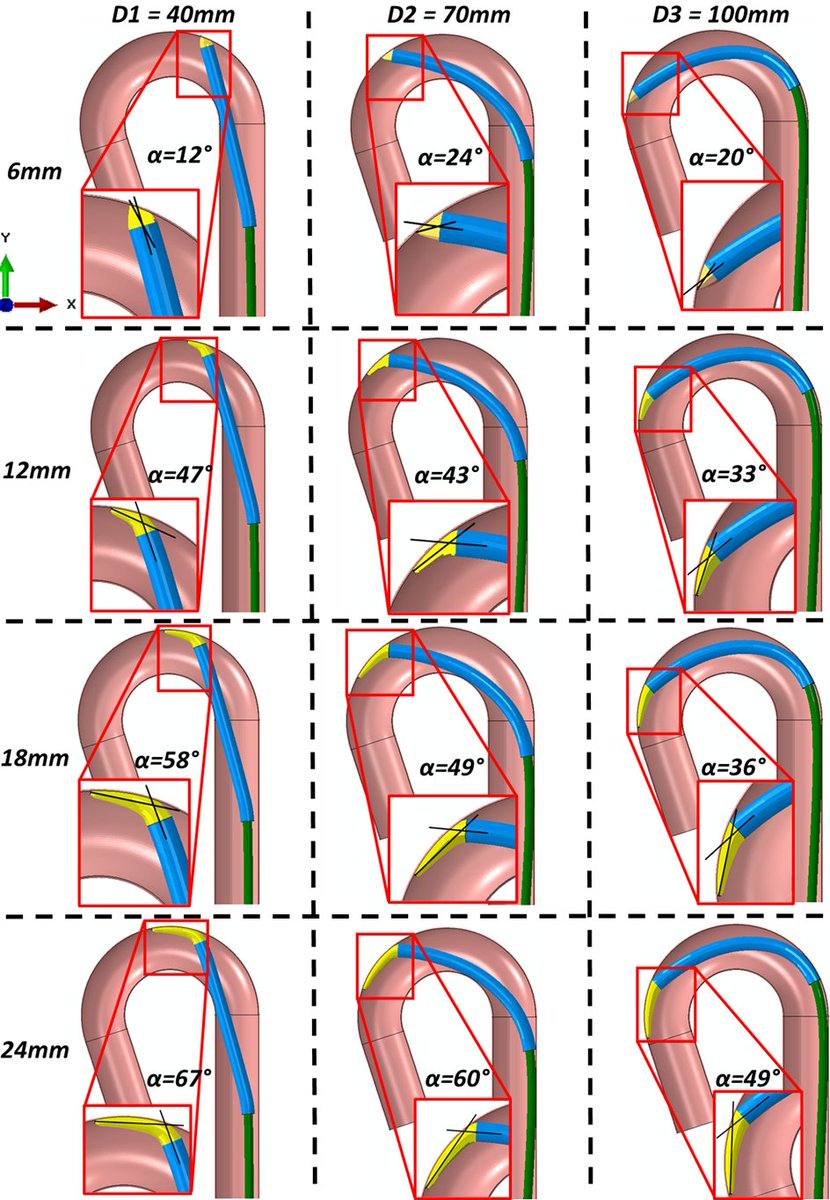 Congrats to @DaveSymes on his 1st paper as 1st author 🥳 investigating aortic vessel and plaque injury risk from catheter tracking during #TAVR intervention
#FEA #MedicalDevice #Biomechanics 
#RCSIdiscover #openAccess
link.springer.com/article/10.100…