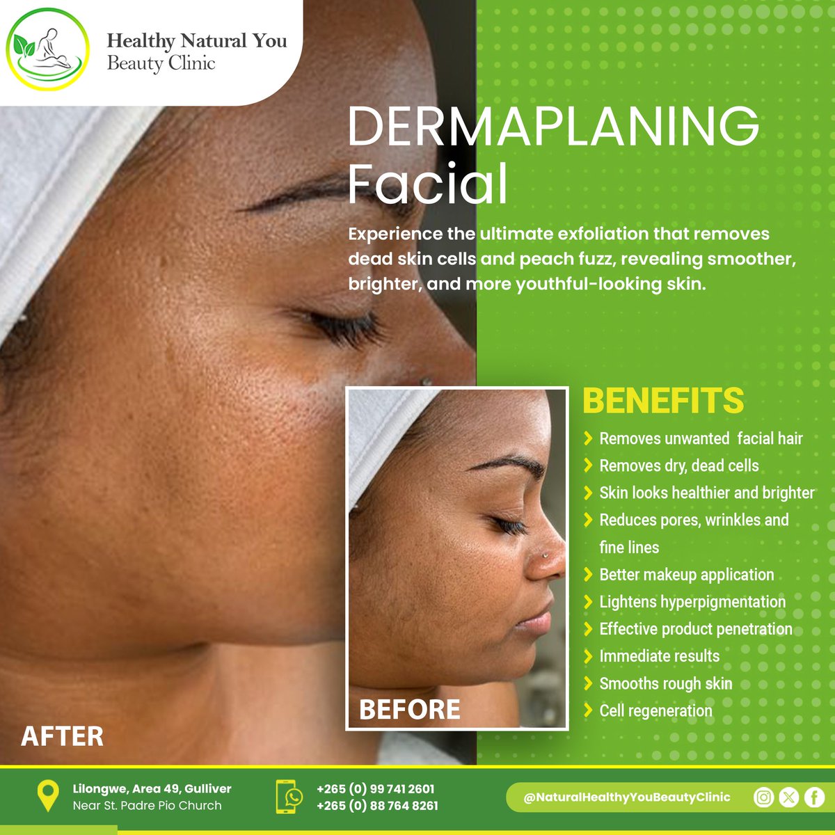 Unlock Your Skin's Radiance ✨ with Dermaplaning!✨ Experience the ultimate exfoliation that removes unwanted facial hair, dead skin cells and peach fuzz, revealing smoother, brighter, and more youthful-looking skin. 💆‍♀️ Book your session now!