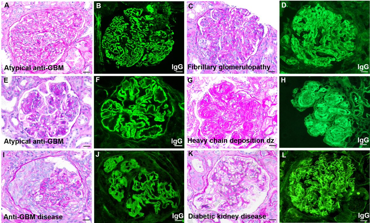 To diagnose anti-GBM disease in the absence of circulating antibodies remains a big challenge. Our response to this recent paper in @AJKDonline (sciencedirect.com/science/articl…) can be found here (sciencedirect.com/science/articl…). It needs more stringent criteria to make such a diagnosis