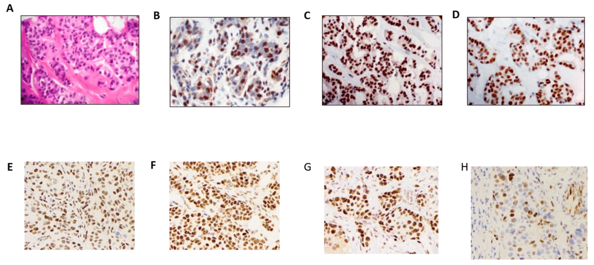 Significant Association of #EstrogenReceptor-β Isoforms and Coactivators in #BreastCancer Subtypes 👥 By Prof. Young Choi and Prof. Simcha Pollack 🏦Yale School of Medicine 🔗mdpi.com/1467-3045/45/3… @MDPIOpenAccess #Estrogen