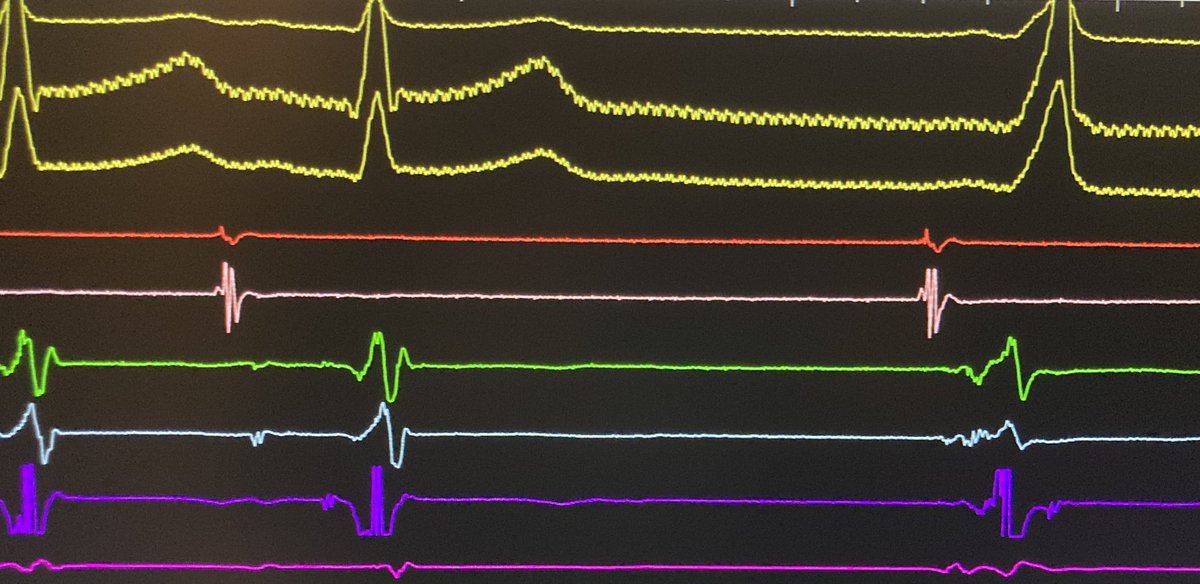 The patient was scheduled for ablation for suspicion of AP mediated symptomatic atrial fibrillation and risk profession.