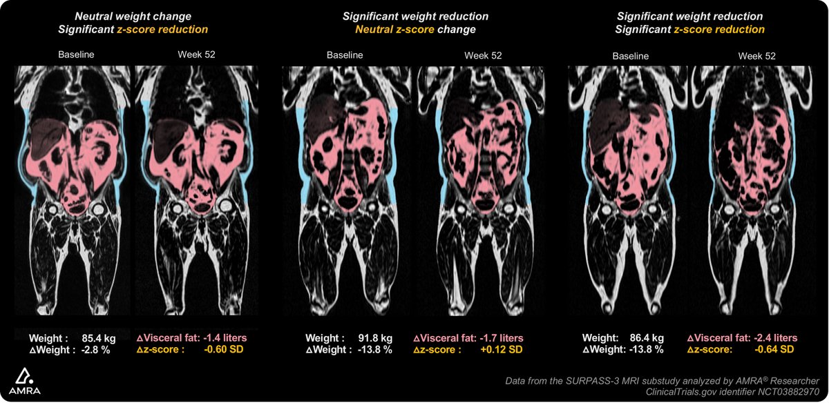 SURPASS-3 MRI study reveals significant reduction of visceral- & liver fat z-scores, & a shift towards a more balanced fat distribution pattern with tirzepatide treatment, according to @AMRAMedical @EliLillyandCo @NantesUniv @UHhospitals @liu_universitet tinyurl.com/39hf7ssk