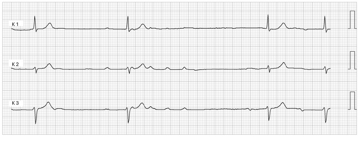 Easy holter-strip; whats going on?