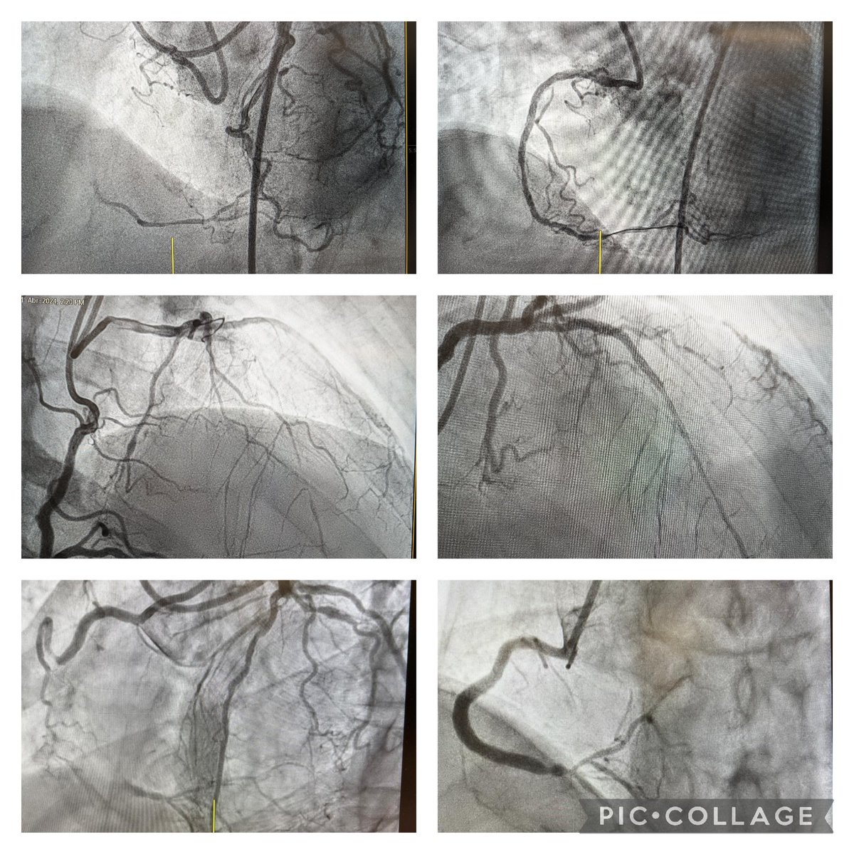 Pablo Salinas (@pabl0salinas) on Twitter photo Ayer 3/3 CTO PCI en #AHO2024.
Casos en vivo realizados por
1️⃣Masahisa Yamane & <a href="/NievesGonzalo1/">Nieves Gonzalo</a>,
2️⃣<a href="/BernatSerra4/">Bernat Serra</a> & <a href="/pabl0salinas/">Pablo Salinas</a>,
3️⃣ <a href="/lmteruelg/">Luis Teruel</a> & <a href="/Jose_A100/">José Antonio</a> Ayer 3/3 CTO PCI en #AHO2024.
Casos en vivo realizados por
1️⃣Masahisa Yamane & <a href="/NievesGonzalo1/">Nieves Gonzalo</a>,
2️⃣<a href="/BernatSerra4/">Bernat Serra</a> & <a href="/pabl0salinas/">Pablo Salinas</a>,
3️⃣ <a href="/lmteruelg/">Luis Teruel</a> & <a href="/Jose_A100/">José Antonio</a>