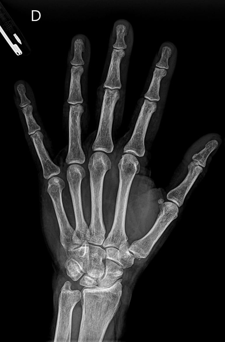 12/4/2024. 🟢 What´s the cause of the advanced radiocarpal osteoarthritis in this patient in this #hand #XRAY? #MSK #radtwitter #orthotwitter