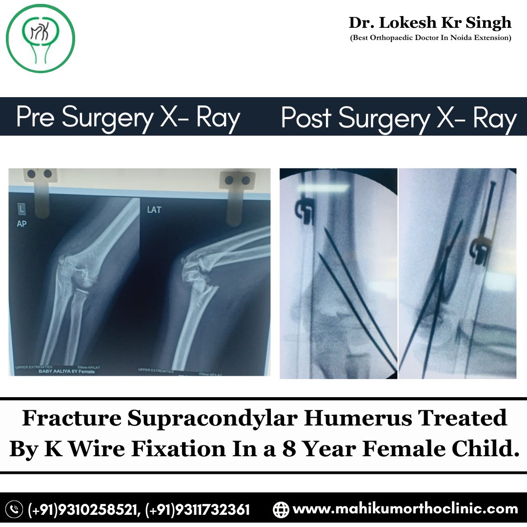 Fracture Supracondylar Humerus Treated By K Wire Fixation In a 8 Year Female Child.
-
Book your appointment @(+91)9310258521, (+91)9311732361
-
#MahikumOrthoClinic #Orthopaedicclinic #fracturesupracondylarlefthumerus #surgery #handsurgery #OrthopedicClinic #Orthopedics