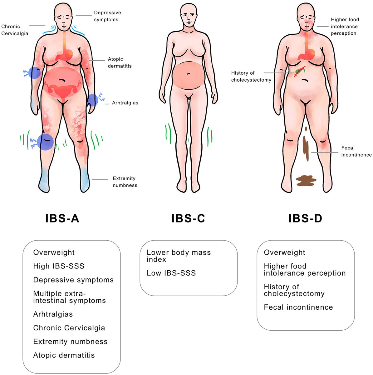 #IBSAwarenessMonth ✅Prevalence of most #extra #IntestinalSymptoms is higher among patients with #IBS-M #RomeIV #Arthralgia 62.4% #ExtremityNumbness 64.5% #AtopicDermatitis 28.2 #ChronicCervicalgia 81.0% 🆕🔥 👉onlinelibrary.wiley.com/doi/full/10.11… @ANMSociety @esnm_eu #GITwitter #MedTwitter